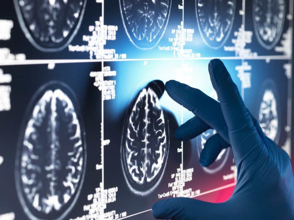 ai-predizionesepsi
